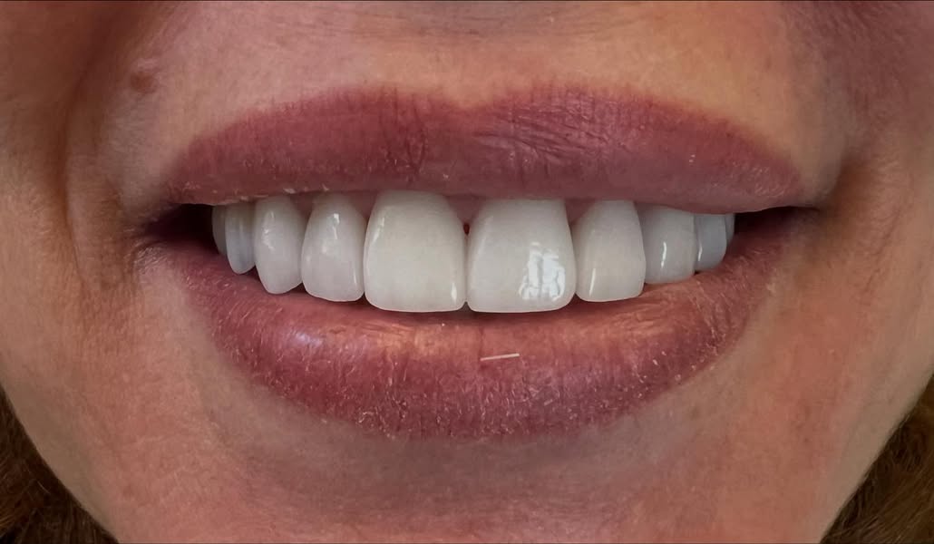 The patient's smile after porcelain veneers at Hingham Dentistry.
