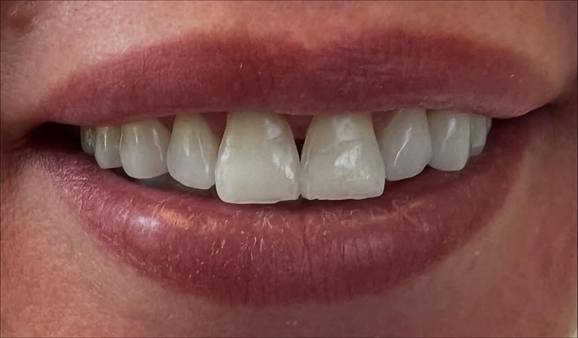 The same patient's smile before porcelain veneers, showing gaps and uneven tooth edges.